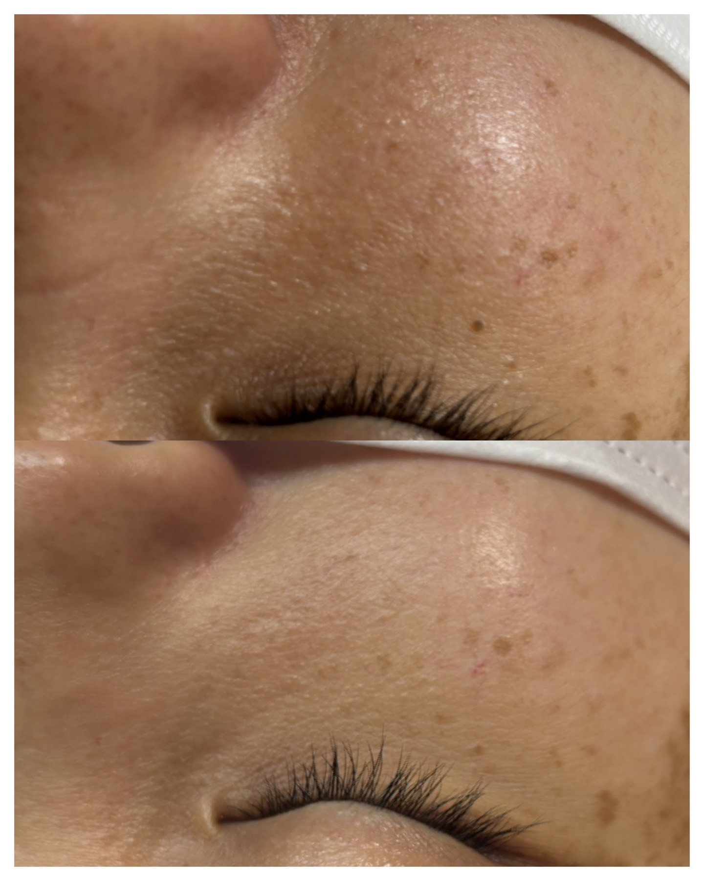 シミケア・イボケア