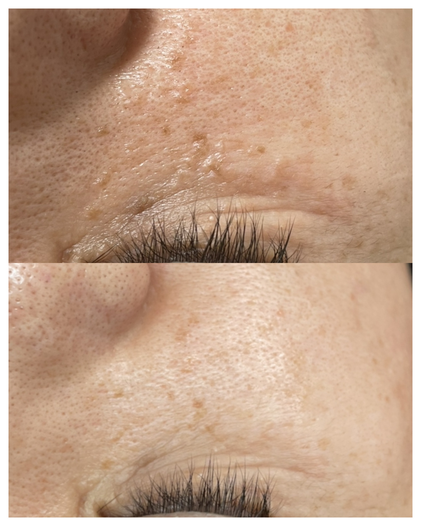 シミケア・イボケア