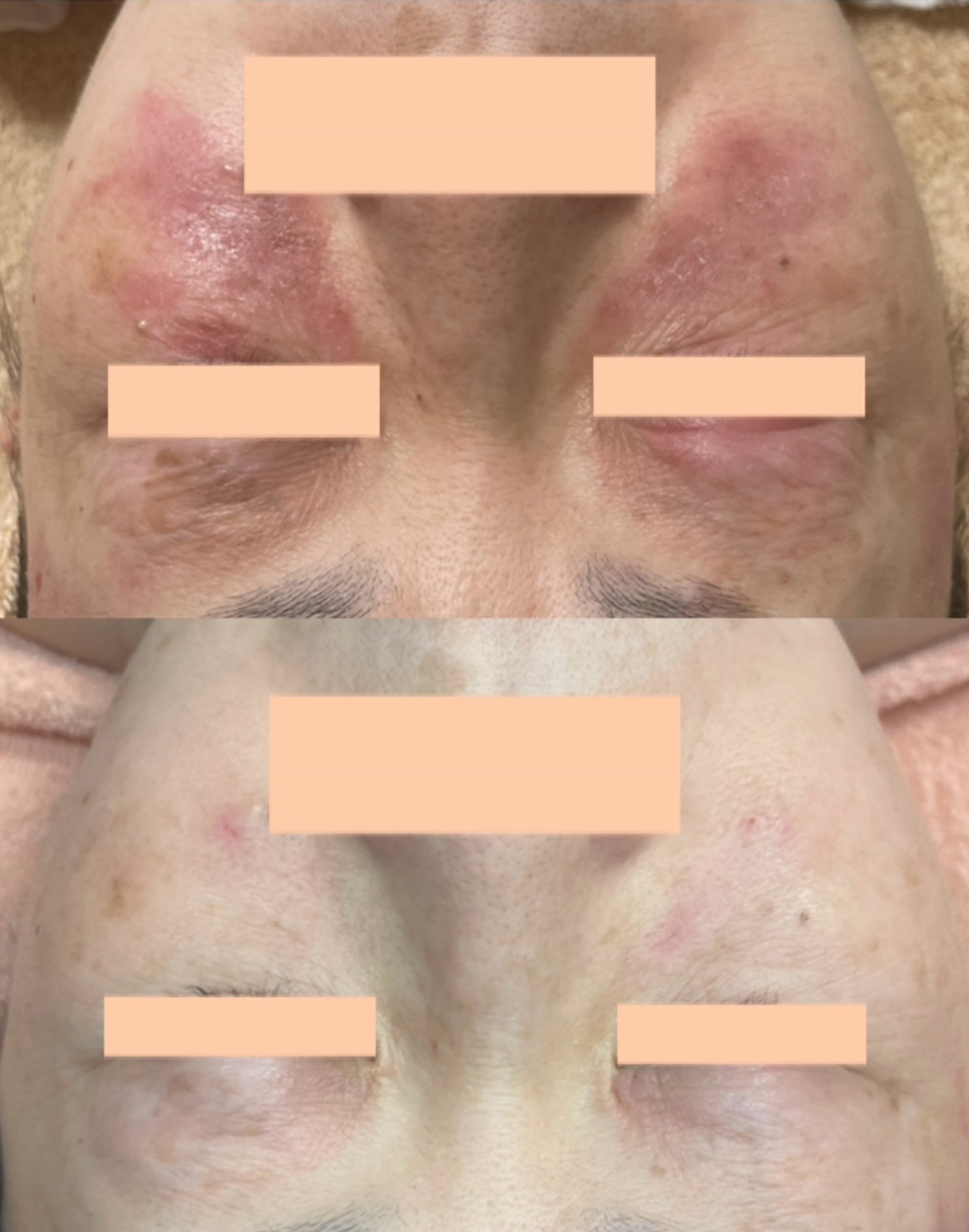 アトピー性皮膚炎の改善