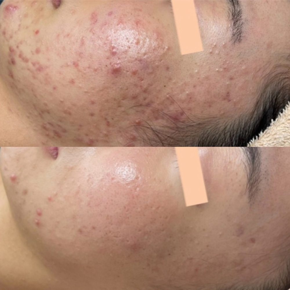 ニキビ肌の改善