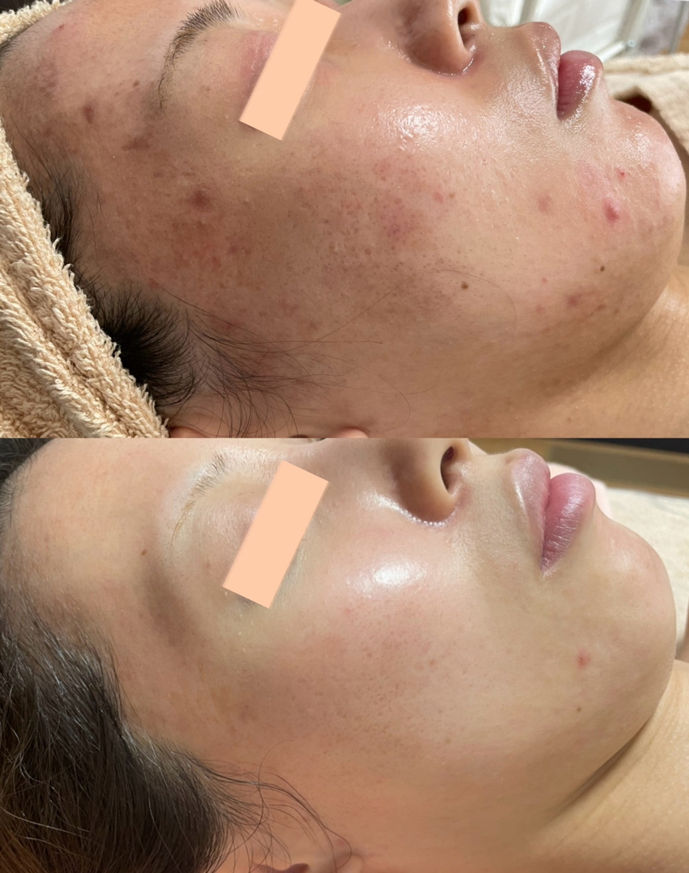 ニキビ肌の改善