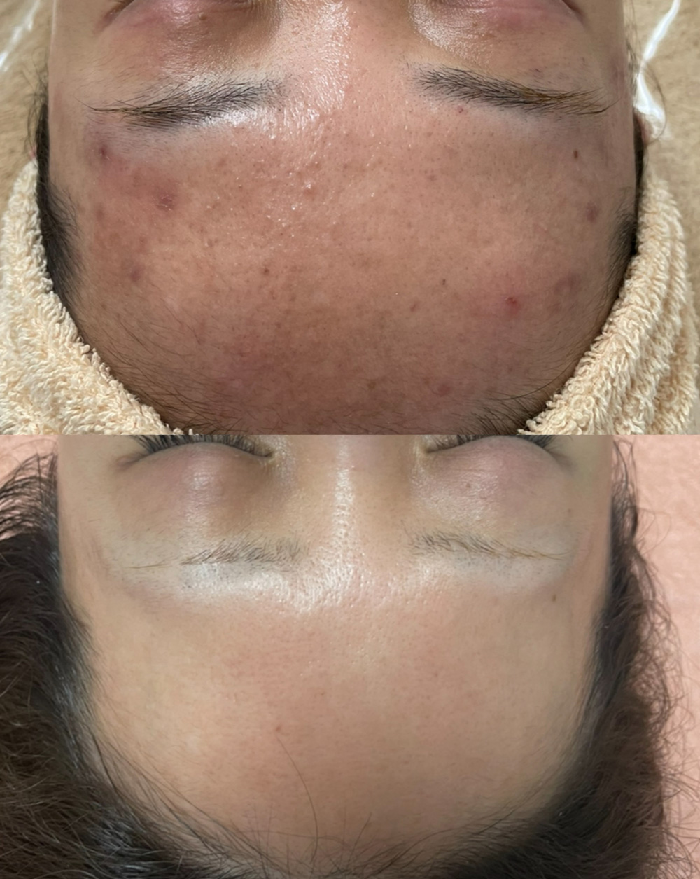 ニキビ肌の改善