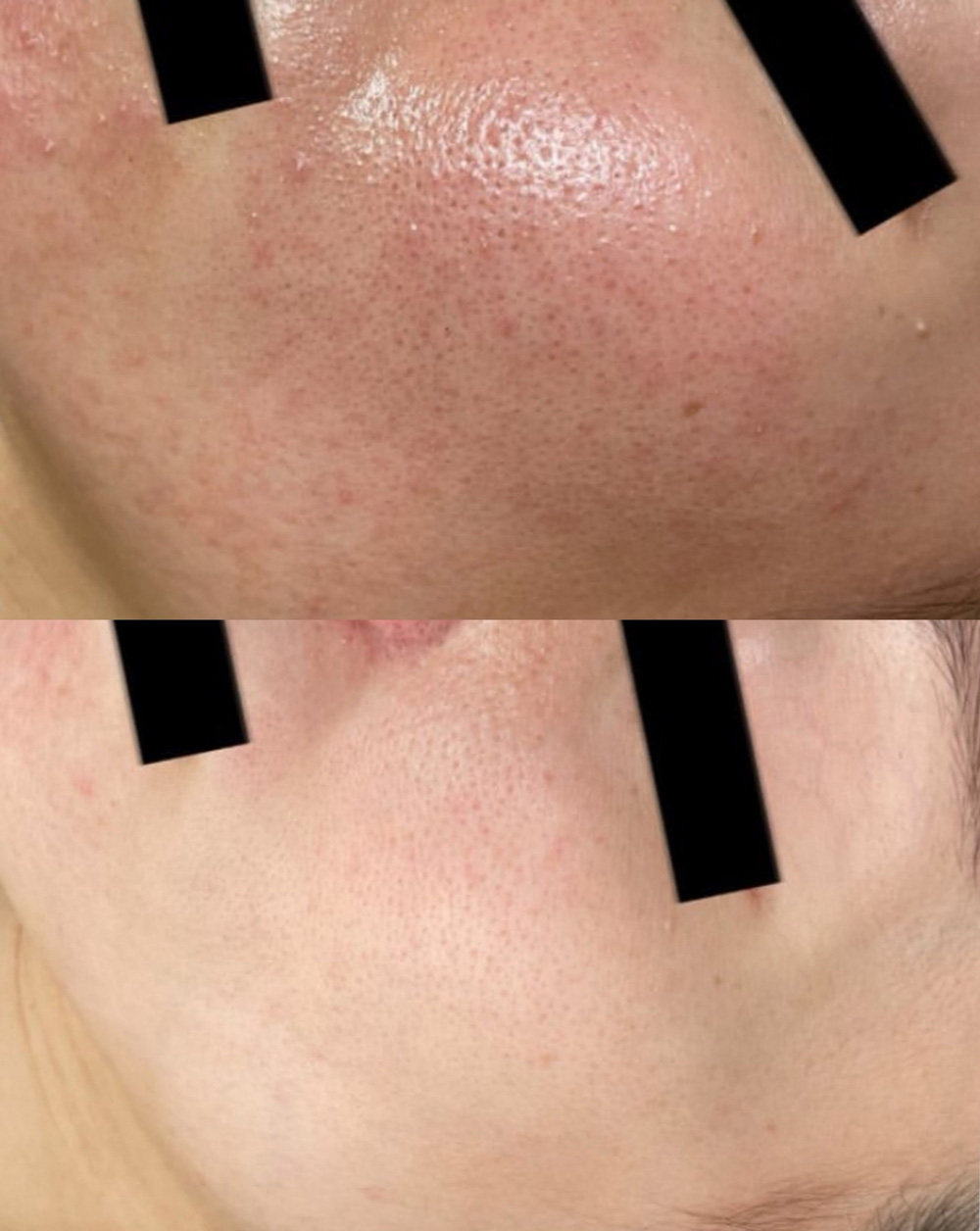 酒さ様皮膚炎の改善