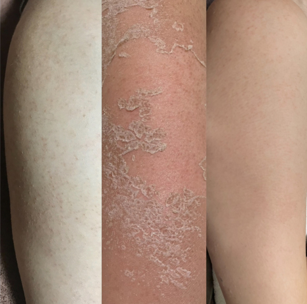 二の腕毛孔性角化症